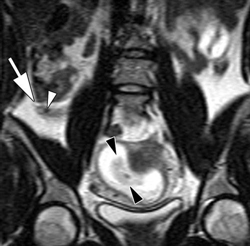 Appendicitis-MRI Better visualization of abnormal appendices and adjacent inflammatory processes Demonstrate the extent ofinflammatory infiltration Visualization of the appendix in an atypical