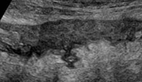 Left colonic divertikulitis-ultrasonography The ultrasound finding is ratherunclear and depends on the stage of the