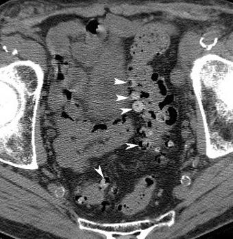 Left colonic divertikulitis-ct CT is the technique of choice for the detection of acute diverticulitis CT has replaced barium enema in evaluation of diverticulitis CT is superior to