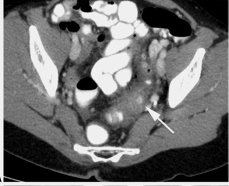 exclud other a pelvic disease CT help to make modified Hinchey stage The grade of severity of acute diverticulitis CT sensitivity for diverticulitis is 79 to 99% Disandvantages CT
