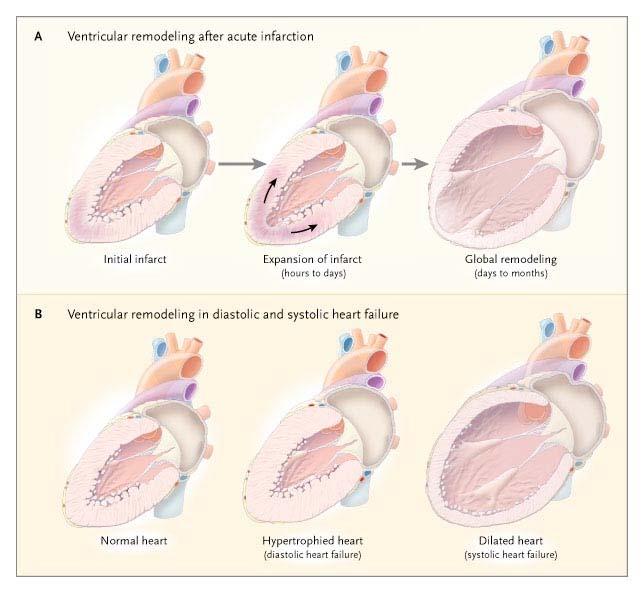Ventricular Remodeling Pathophysiology of Heart Failure