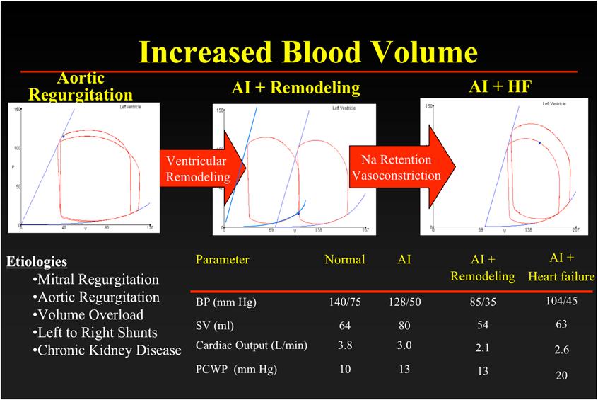 Aortic Regurgitation Increased Blood Volume AI + Remodeling AI + HF Ventricular Remodeling Na Retention Vasoconstriction Etiologies Mitral Regurgitation Aortic Regurgitation Volume Overload Left to