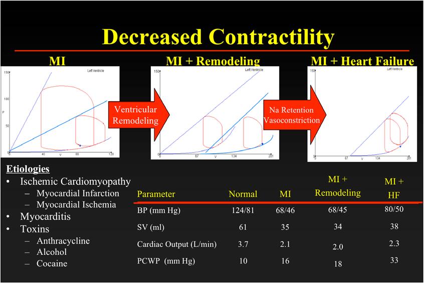 MI Decreased Contractility MI + Remodeling MI + Heart Failure Ventricular Remodeling Na Retention Vasoconstriction Etiologies Ischemic Cardiomyopathy MI + MI + Myocardial Infarction Parameter Normal