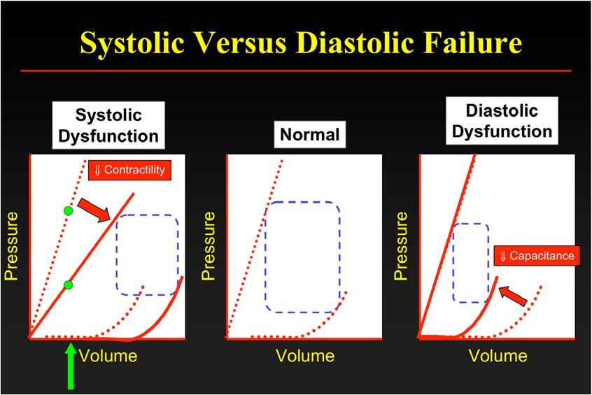 Systolic Versus Diastolic Failure Systolic Dysfunction Contractility Normal Diastolic