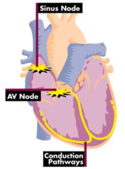 Normal Conduction Atrial Fibrillation Atrial Fibrillation (AF) is a very common heart rhythm disorder where the heartbeat is irregular and rapid.