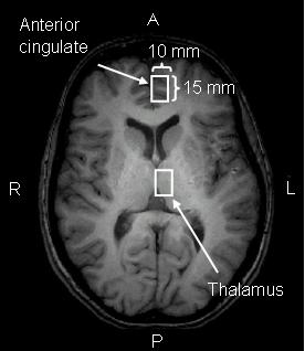 42 Figure 2-1: Voxel localization. The white rectangles represent spectroscopy voxels in the left anterior cingulate and the left thalamus.
