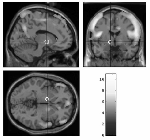 47 respect to the cross-sectional images of the T1-weighted template, centred at the left thalamus.