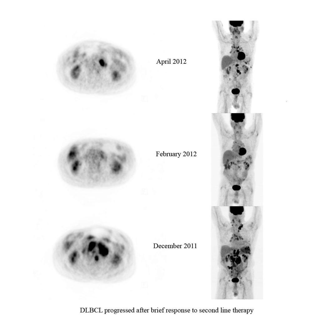 FDG PET in Lymphoma Disease