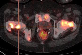 Prostate Cancer Revealing Heterogeneous Biology of Tumor Metastasis Tumor heterogeneity is the key factor limiting