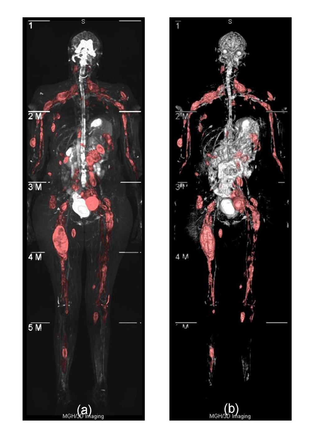 Neurofibromatosis 1 Genotype is known Imaging used for surveillance of disease manifestations: Has the disease
