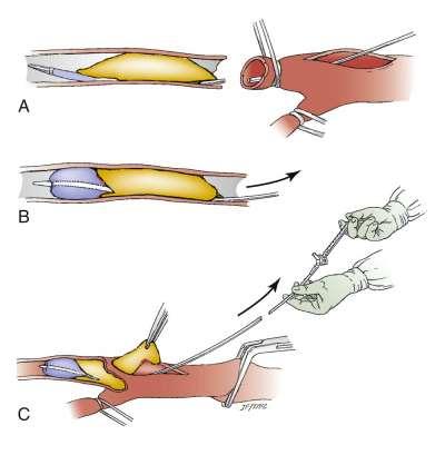 Acute Limb Ischemia: Open Surgical Treatment Classic Thromboembolectomy: Proximal and distal control Catheter passage beyond
