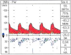 Flow Acceleration FA = Peak systolic