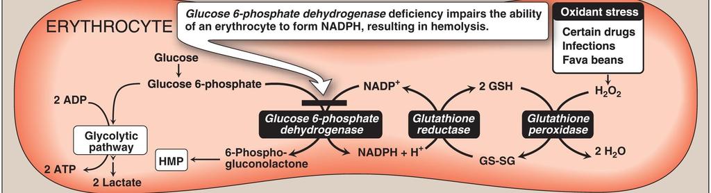 Glucose 6-phosphate dehydrogenase deficiency Missense mutation in G6PD lead to Glucose 6- phosphate dehydrogenase deficiency