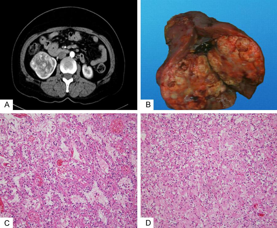 Figure 1. A. The CT showed us the tumor has abnormal blood vessels and a slight blurring in the perirenal fat space, which was considered as a malignant tumor. B.