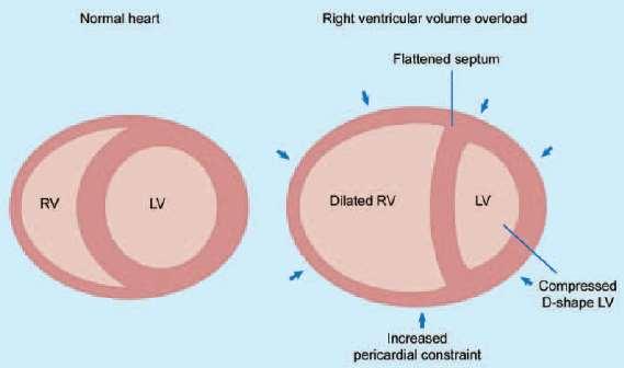 PE: acute right heart overload