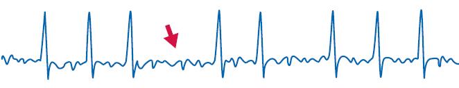 Electrocardiogram: loss of P wave in AF P Normal sinus rhythm Normal heart rate Regular rhythm P Waves Steady baseline No P AF Heart