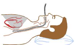 Transoesophageal echocardiogram Ultrasound transducer positioned close to the heart using an