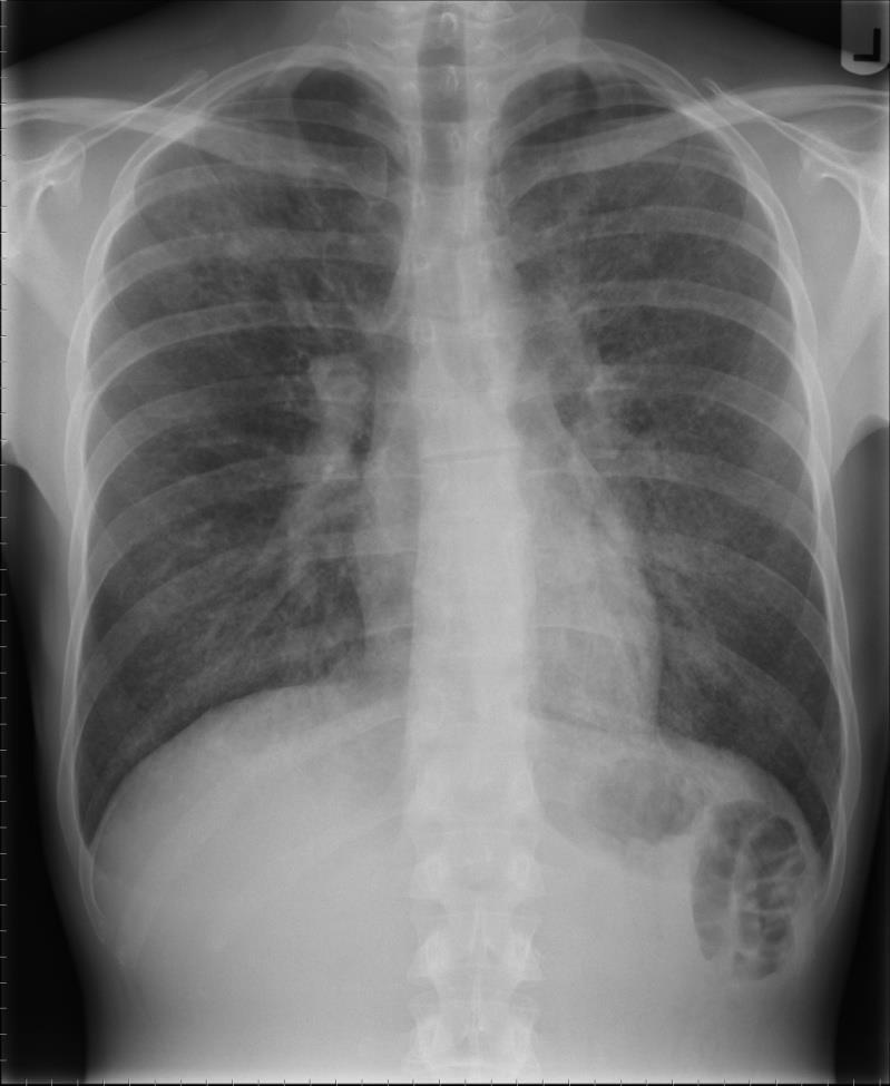 Chest Radiography When clinical findings suggest an abnormality chest radiography may be used to Evaluate