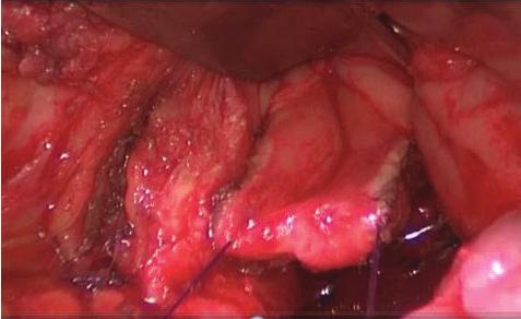 (d) After preparing rectal advancement flap, its fixation with interrupted sutures one by one is seen.