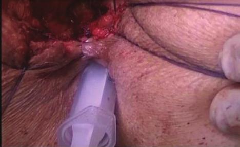 (b) Closed posterior rectal wall is seen.