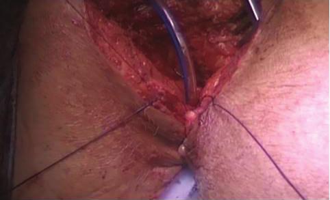 operation. (d) Closed skin incision of the York Mason operation is seen.
