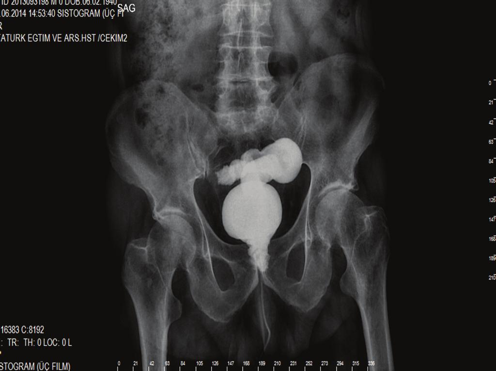 6 Case Reports in Urology References Figure 9: Leakage of radiopaque material filling the rectum by passing through rectourethral fistula was seen preoperatively in cystography.