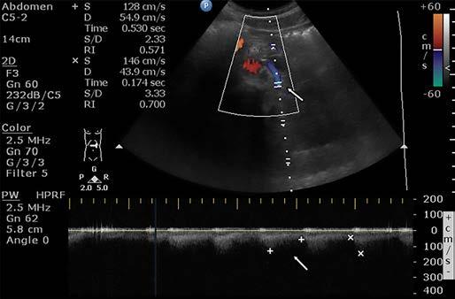 384 Fig. 5. Color and spectral Doppler exam (triplex Doppler) of the left renal artery.