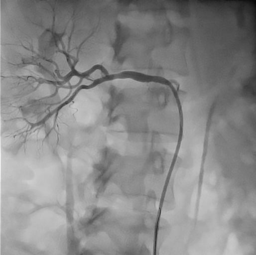 385 involvement of branch arteries negatively are negative factors which affect the treatment [16].