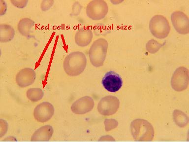 Normal diameters of erythrocytes in blood When suspended in an isotonic medium, human erythrocytes