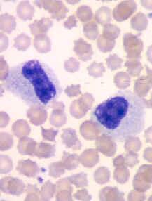Neutrophils (Polymorphonuclear Leukocytes) Immature neutrophils that