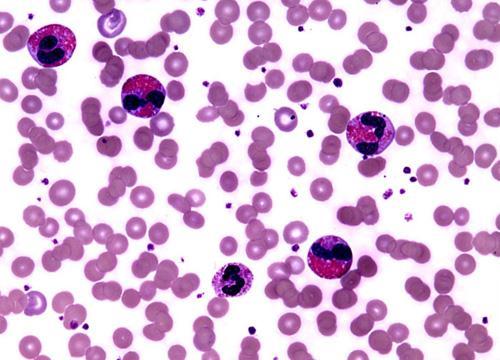 Eosinophilia An increase in the number of eosinophils in blood is associated with allergic reactions and helminthic (parasitic) infections.