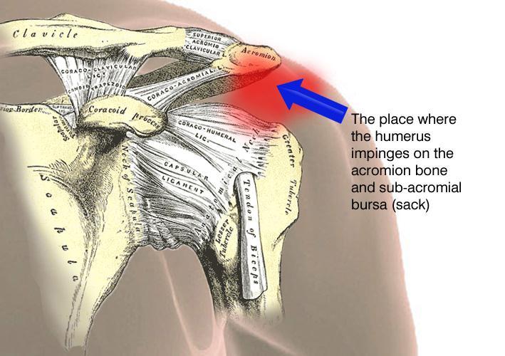 So if you lift your arm up that s where it hurts, it impinges, and the place you feel your pain is running down your arm, sometimes all the way to your elbow. That is the commonest shoulder problem.