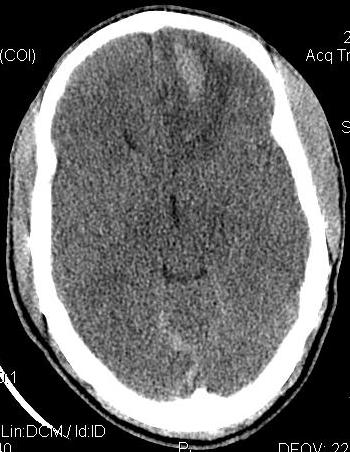well as subarachnoid hemorrhage noted within the falx cerebri Fig 4.