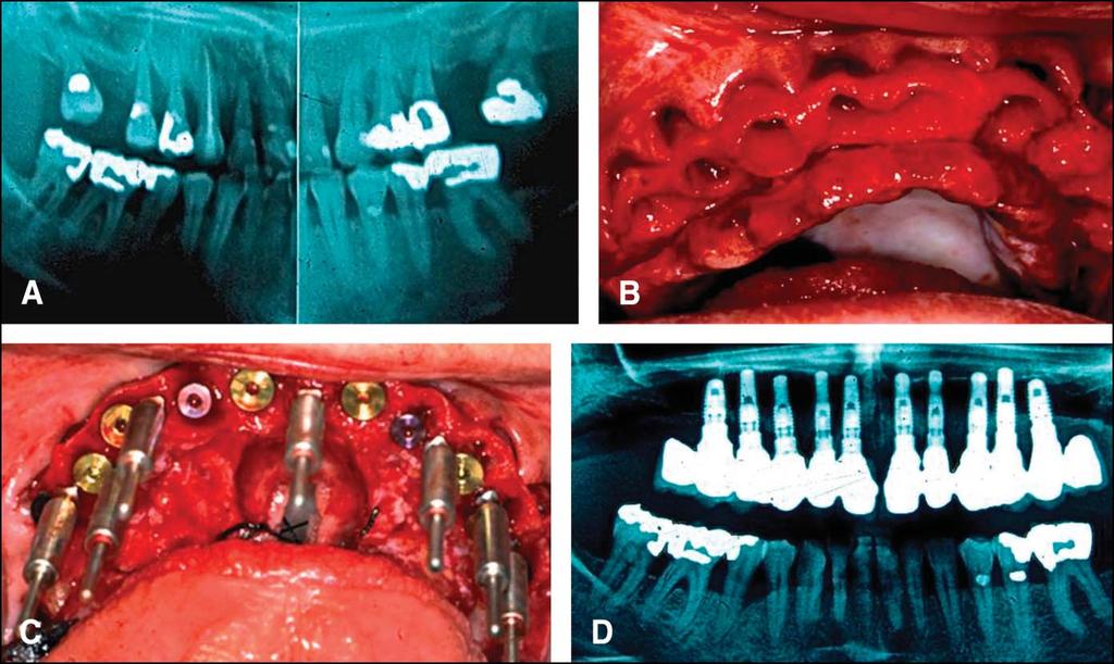IMPLANT DENTISTRY / VOLUME 0, NUMBER 0 2014 3 Fig. 1. A, Preoperative radiographic image of a 47-year-old patient who presented with a hopeless maxillary dentition.
