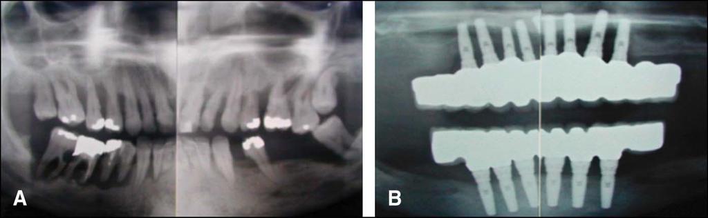 C, Intraoperative view showing the placement of immediate provisional implants in the edentulous sites between the standard implants to allow for delivery of a fixed provisional restoration and allow