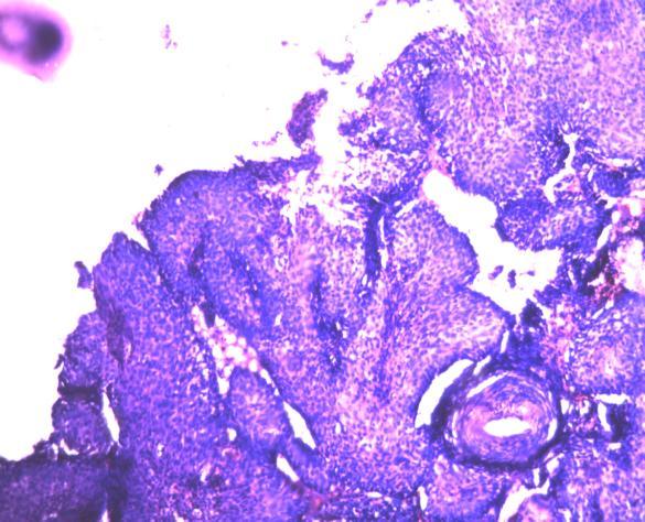 Neoplastic lesions presented with pain abdomen, irregular bleeding and post menopausal bleeding. Figure 7: Squamous cell carcinoma- Showing pleomorphic cells with irregular nuclei. (Pap, 40X).