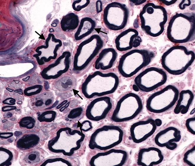degeneration (arrowhead). The adjacent fiber is intact and demonstrates a node of Ranvier (arrow). Osmium tetroxide stain. From Jortner 2000, with permission. FIGURE 10.