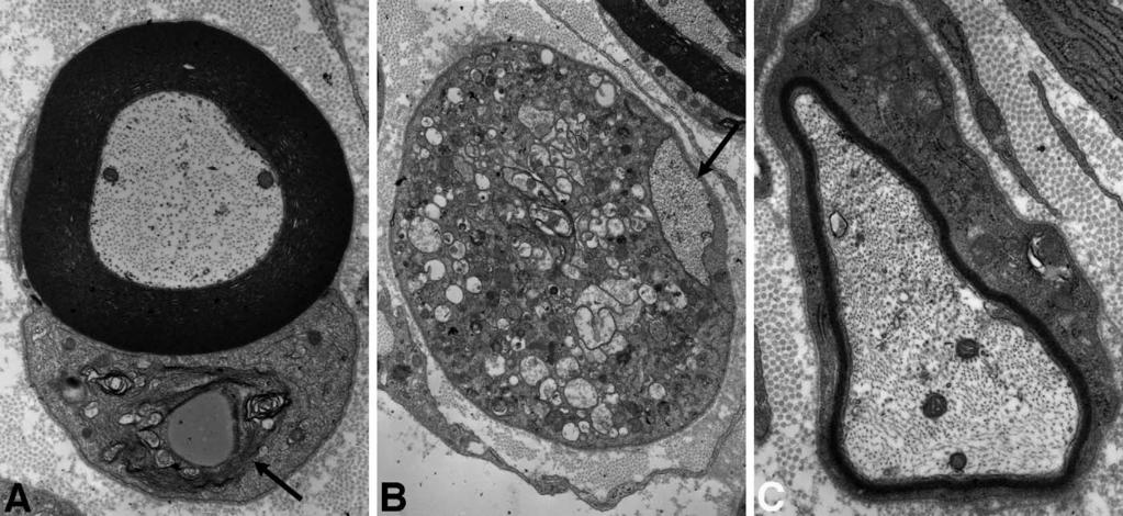 72 JORTNER TOXICOLOGIC PATHOLOGY FIGURE 12. Cross-sections of sciatic nerve fibers from neonatal rats fed a diet containing 1.25% elemental tellurium (specimens provided by Dr.