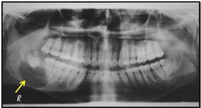 Hence it may resemble ameloblastoma, dentigerous cyst, lateral periodontal cyst and radicular cyst.
