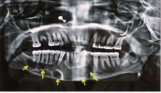 Obliteration of buccal vestibule overlying mucosa was normal with no mobility of teeth.