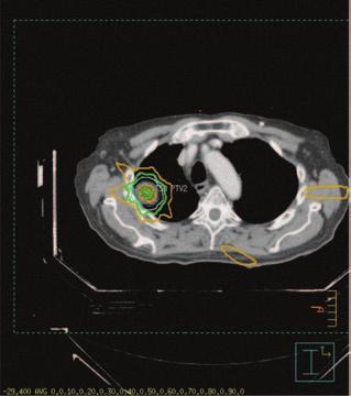 SABR can deliver the same total dose as conventional radiation but in far fewer actual treatments, providing a theoretical and practical biologic tumor control benefit.