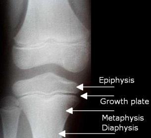 If there is epiphyseal growth plate at the lower end of humerus that mean: -If the person was male ( ), he is below the age of 18. -If the person was female ( ), she is below the age of 16.
