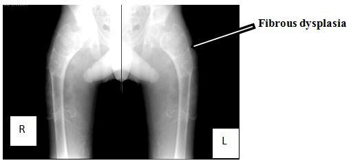 Radiographic staging of bone involvement can be found in imaging studies below: Fibrous Dysplasia on X-ray On plain films, fibrous dysplasia is an intramedullary, expansile, and well-defined lesion