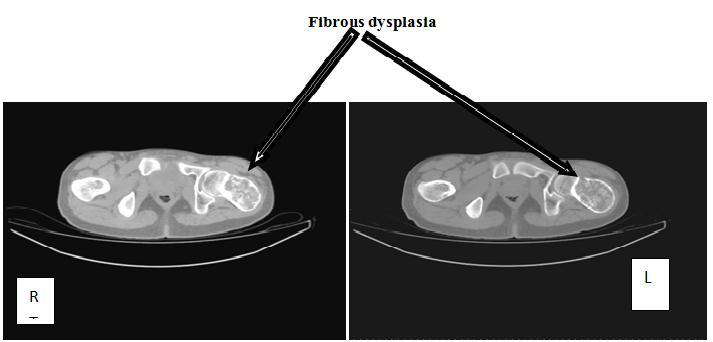 Fig-2: Two axial CT images of the upper left