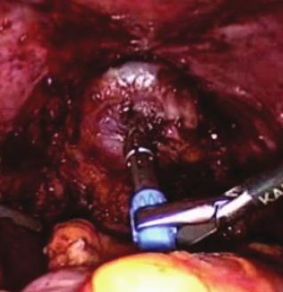 This more conservative approach to segmental bowel resection allows preservation of vasculature, lymphatics and nerve supply; thereby minimizing functional complications.