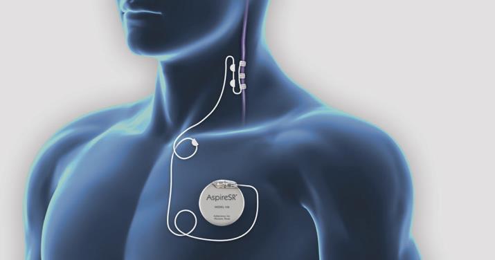Vagus Nerve Stimulation Therapy Non-pharmacological therapy for epilepsy Repeated electrical stimulation of the left vagus nerve by the pulse generator