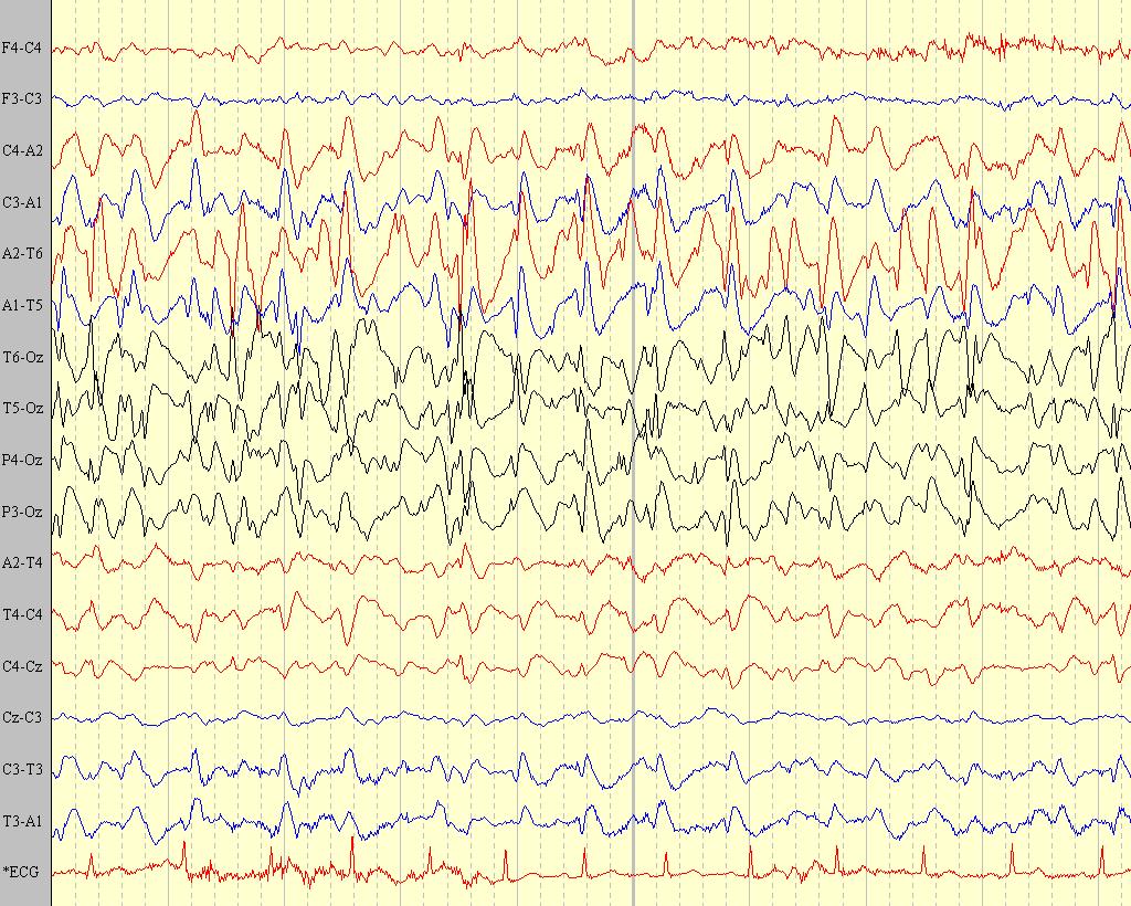 deviation, hemi or generalised szs may develop = autonomic epilepsy Eye closure Reading EEG may show multifocal or