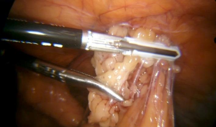 Page 2 of 7 Laparoscopic Surgery, 218 A B C D E F G H Figure 1 Steps involved in the laparoscopic umbilical herniorrhaphy.