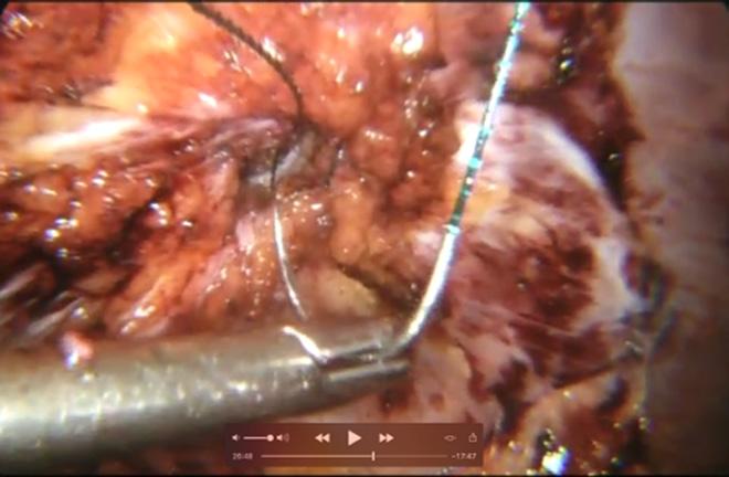 repair (7). The repair of inguinal hernias is standardized across the surgical community thanks to the robust evidence of laparoscopic mesh repairs.