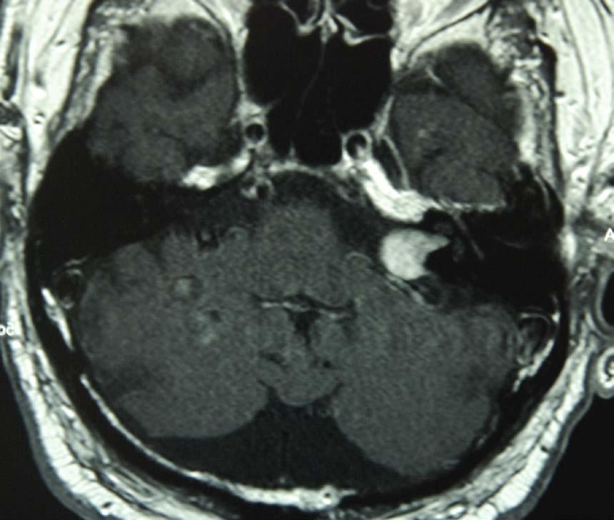 Right acoustic schwannoma.